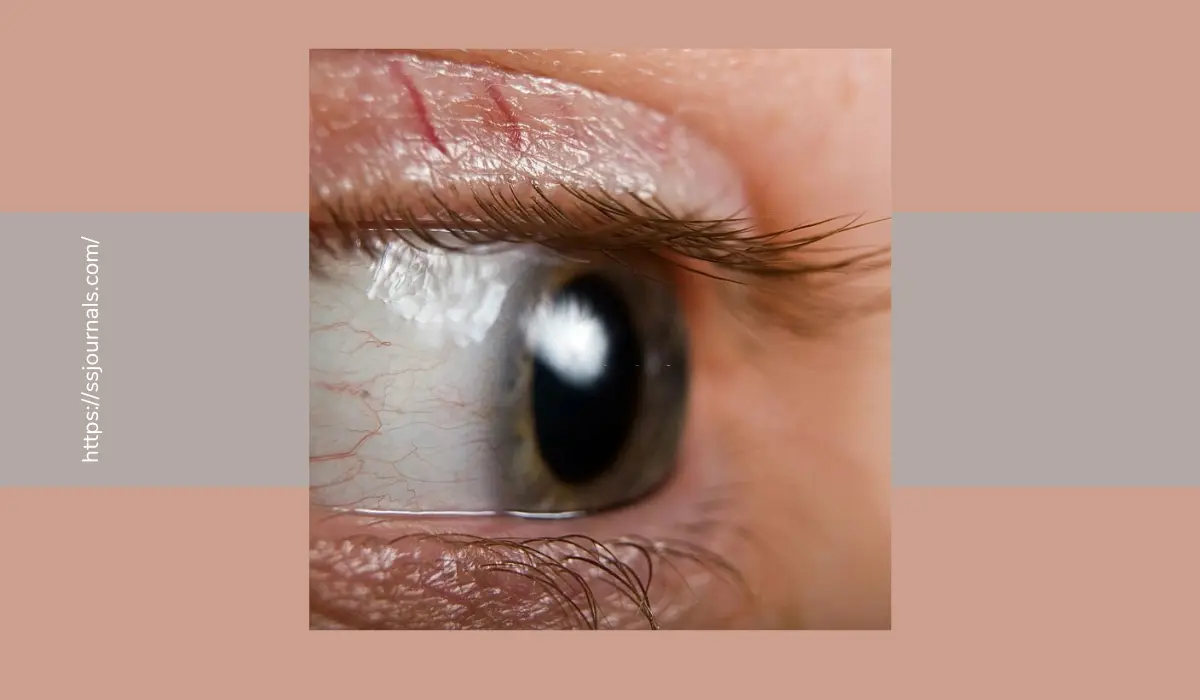 Ocular Tuberculosis