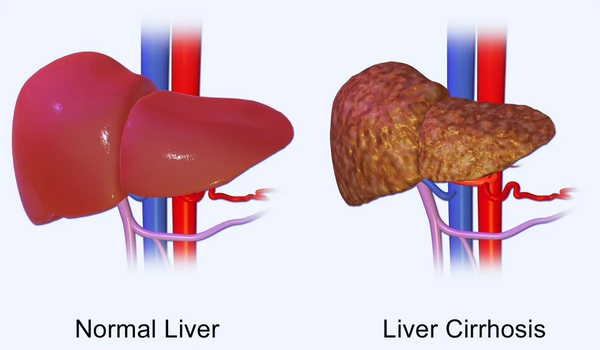 Orthotopic Liver Transplant