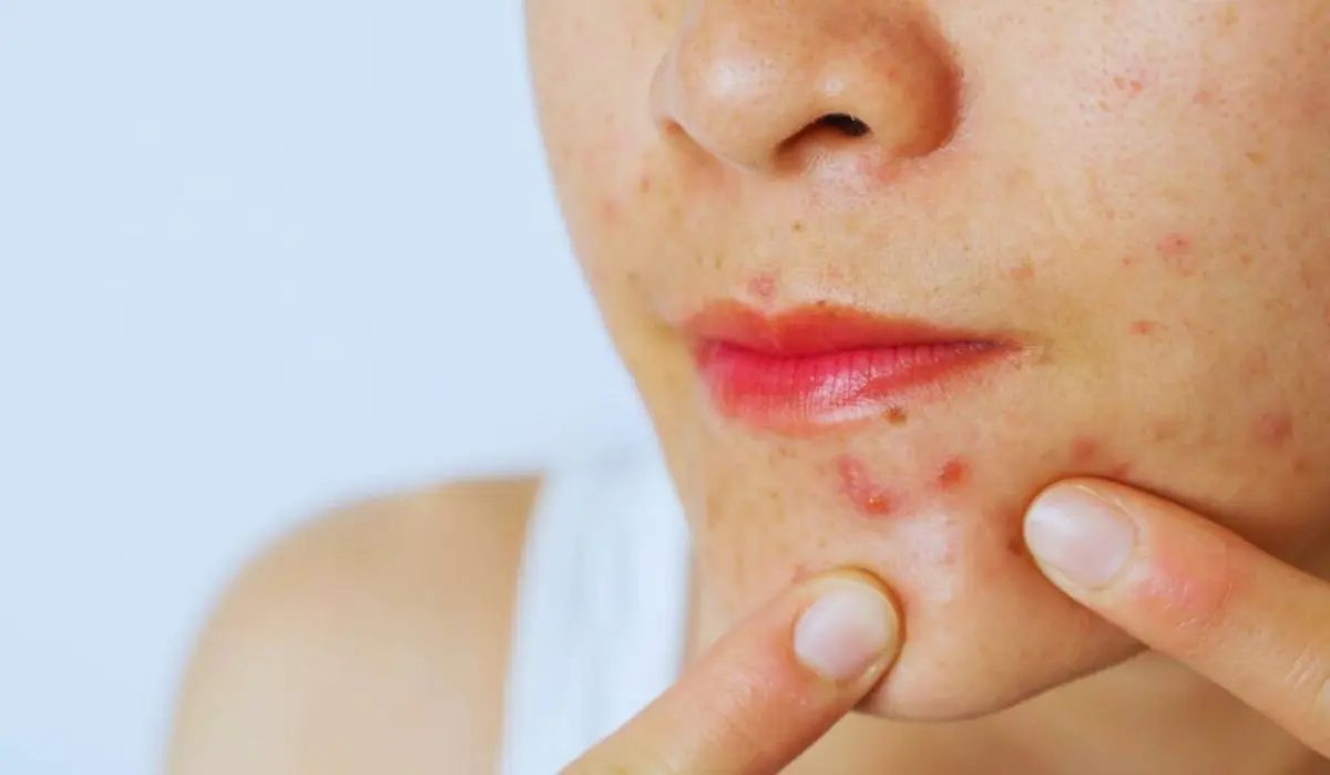 Symptoms Of Chlamydia Rash On The Face