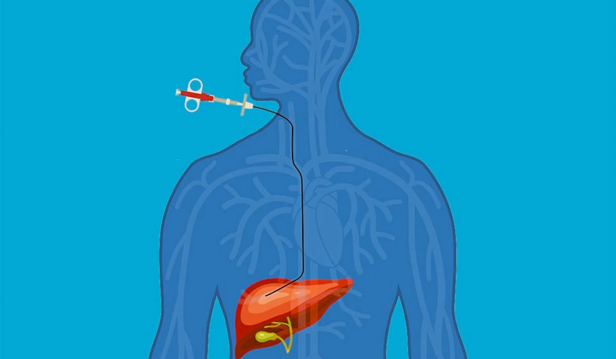 Transjugular Liver Biopsy.
