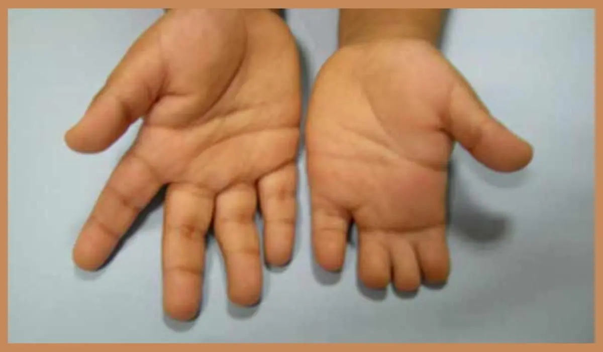 Types Of Congenital Hand Deformities