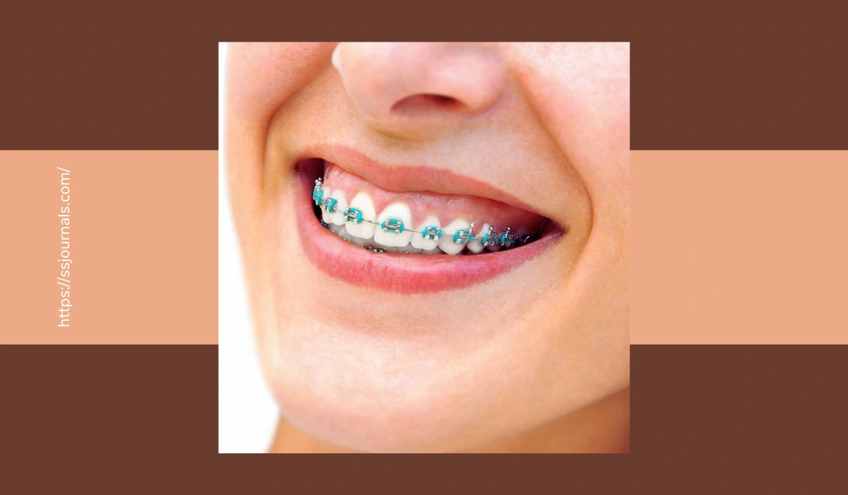 Whiten Teeth With Braces