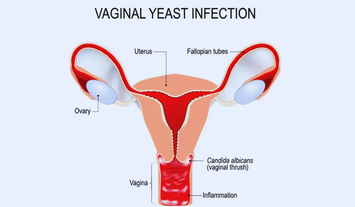 Yeast Infection While On Period