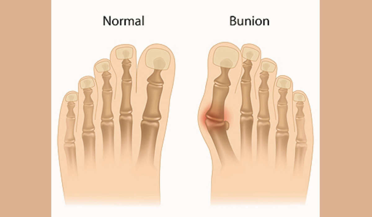 Getting to Know Bunions
