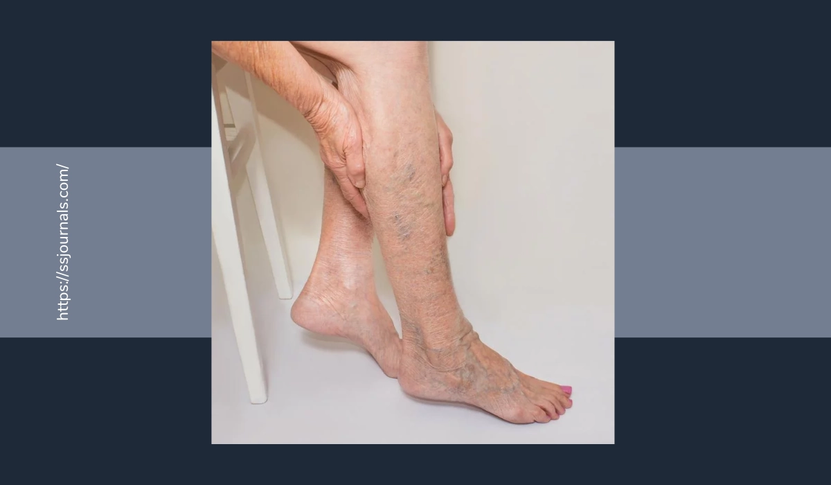 4 Ways To Reverse Venous Insufficiency Naturally