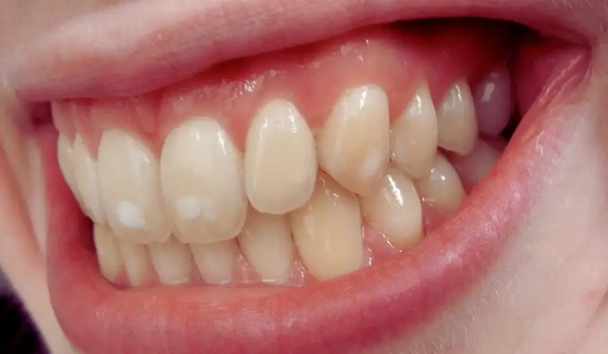 Calcium Deposits On Teeth