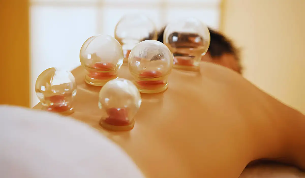 Cupping Therapy Practice