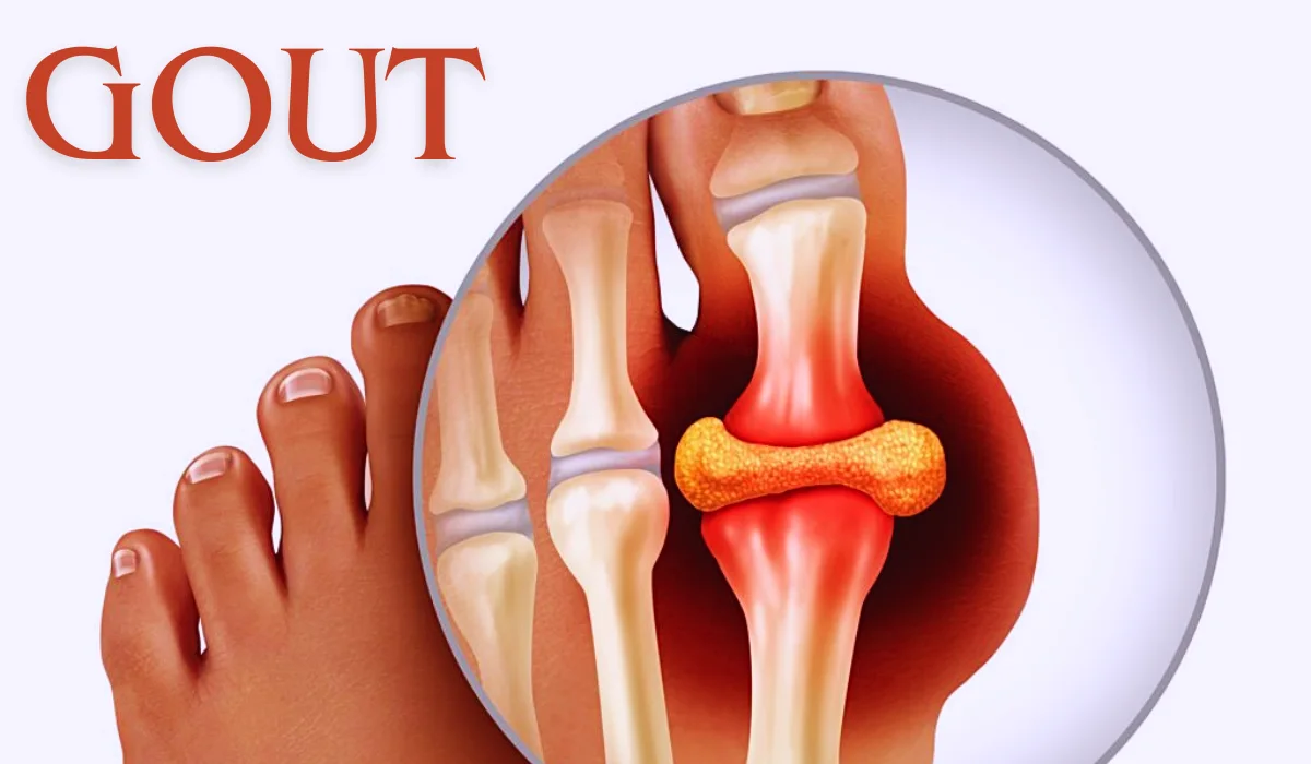 Difference Between Gout And Bunion