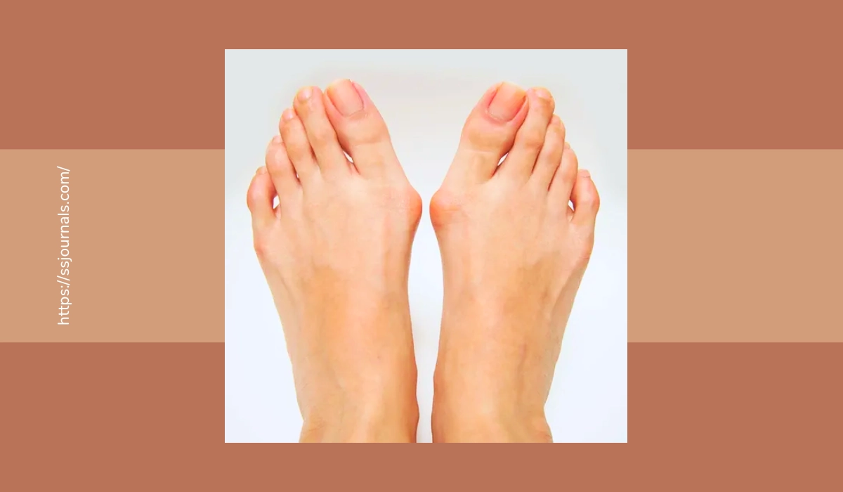 Gout vs Bunion