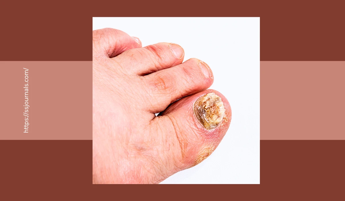 Homeopathic Remedies For Toenail Fungus