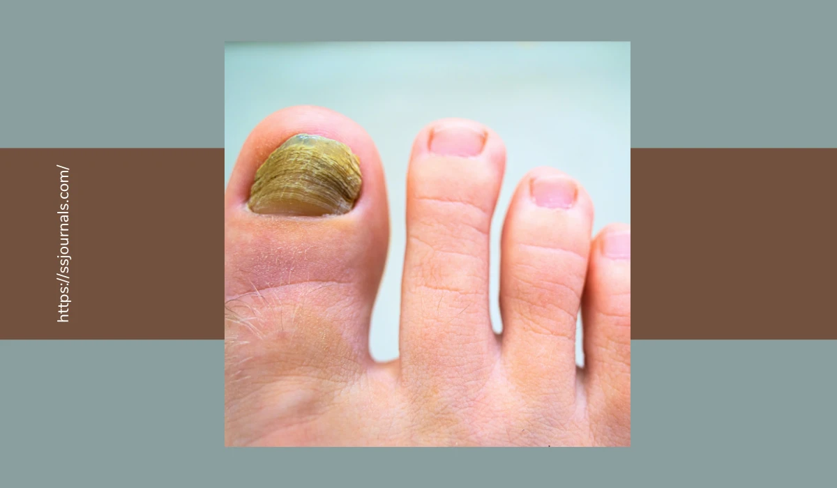 How To Get Rid Of Green Nail Fungus