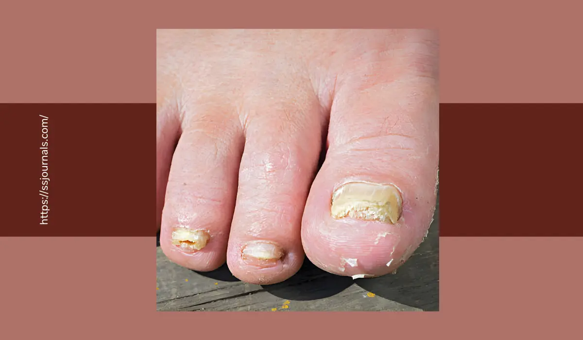 How To Know If Toenail Fungus Is Dying