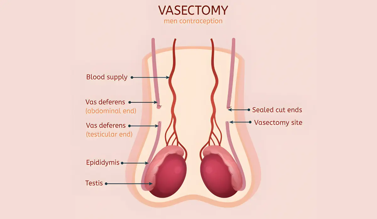 Negative Effects of Vasectomy