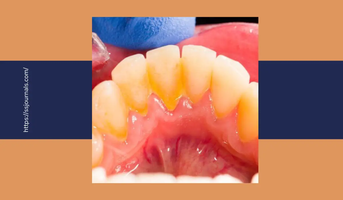 Prevent Calcium Deposits On Teeth