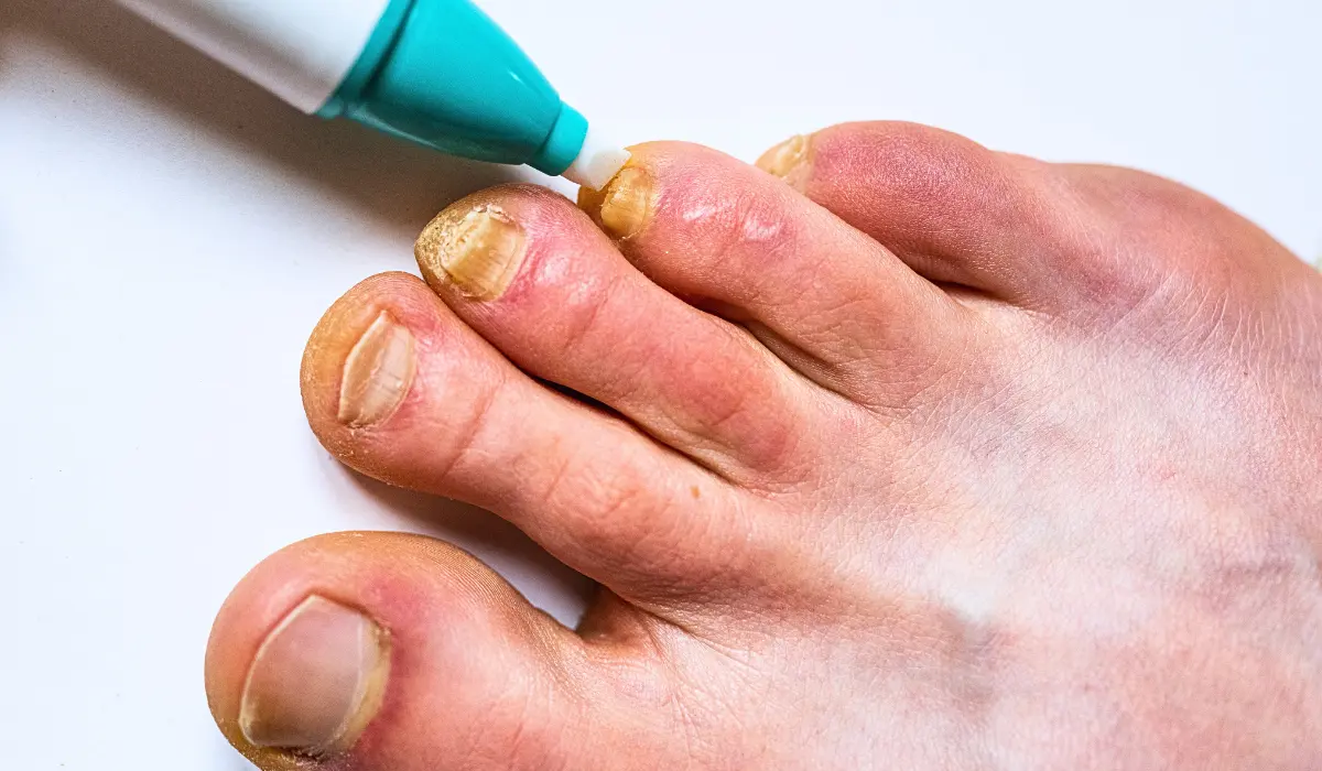 Remedies For Toenail Fungus