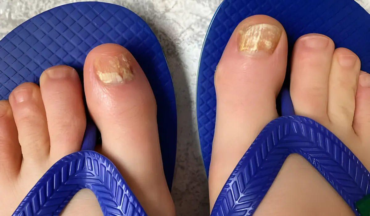 Toenail fungus Medical treatments