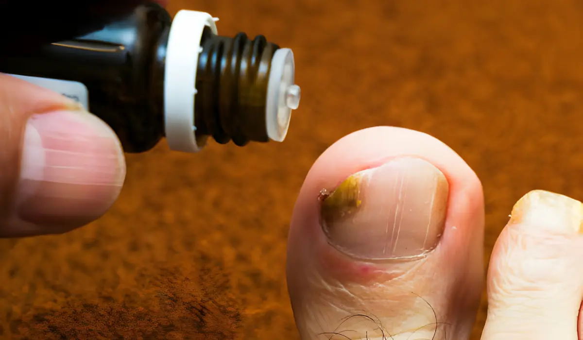 Treatment Plans For Fungal Nail Infections