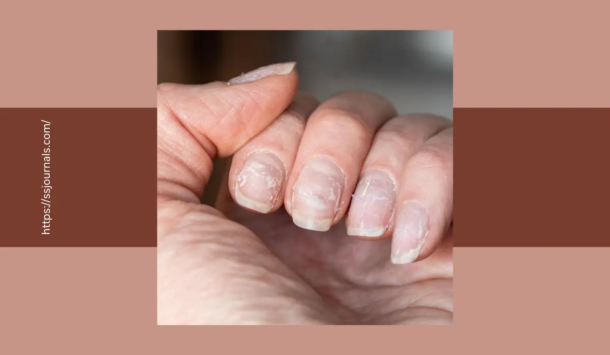 How To Cure Fingernail Fungus Fast