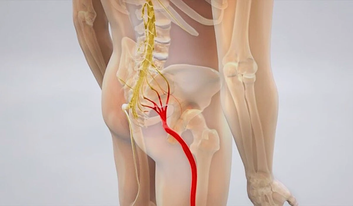 Late-Stage Sciatica