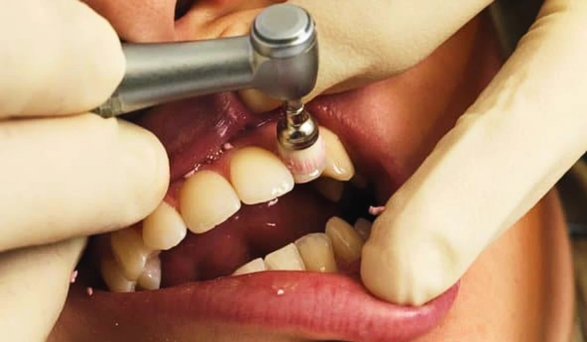 Prophylaxis Dental