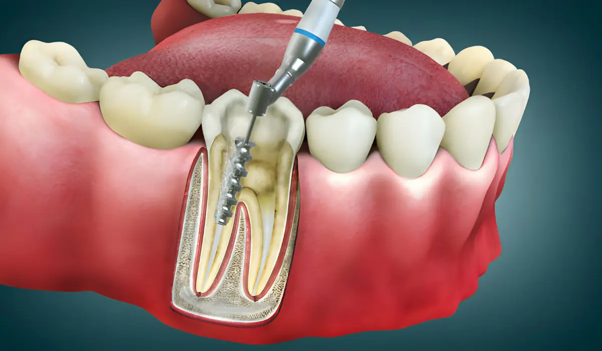 Tips To Prevent Pressure Pain On Root Canal Tooth
