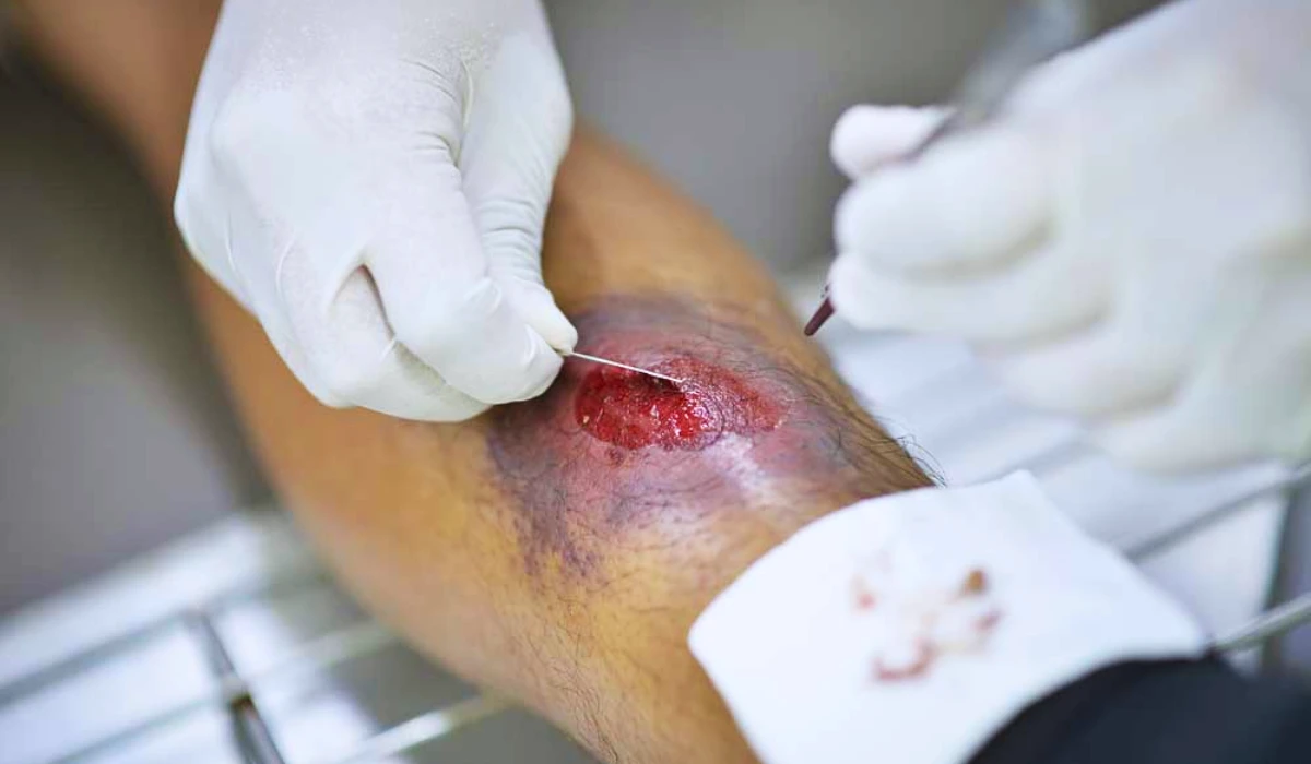 Treatment of Periwound Skin