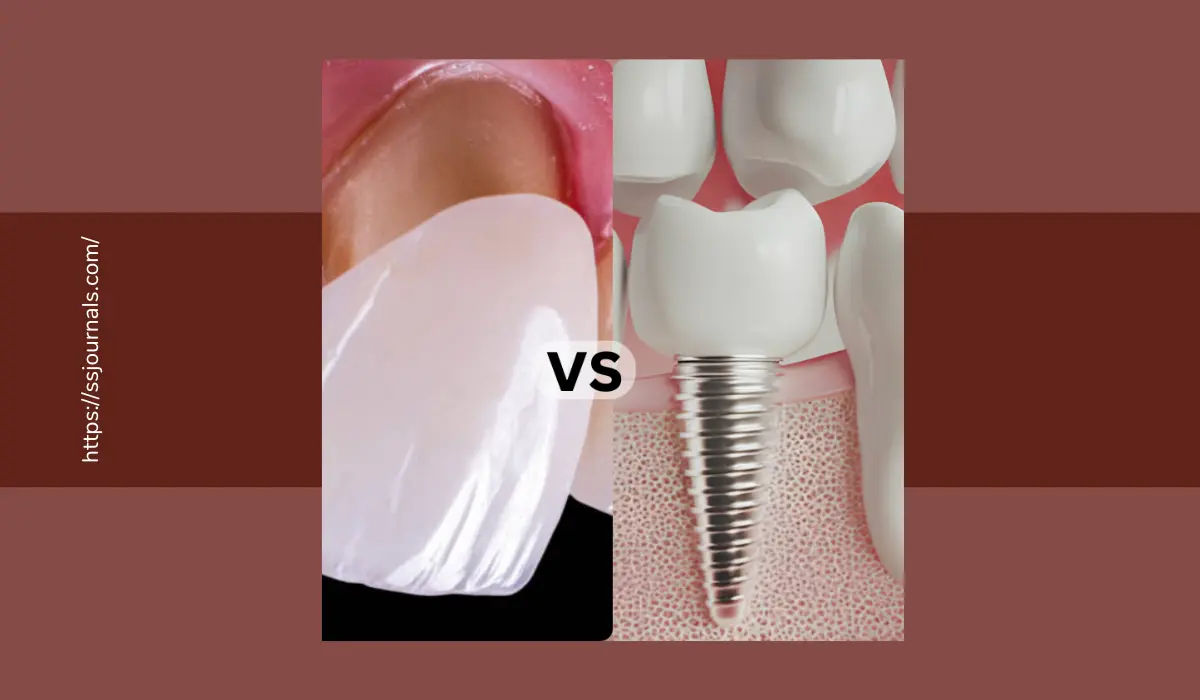 Veneers vs. Implants For Tooth Replacement