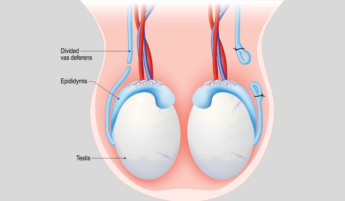 vasectomy lower testosterone levels